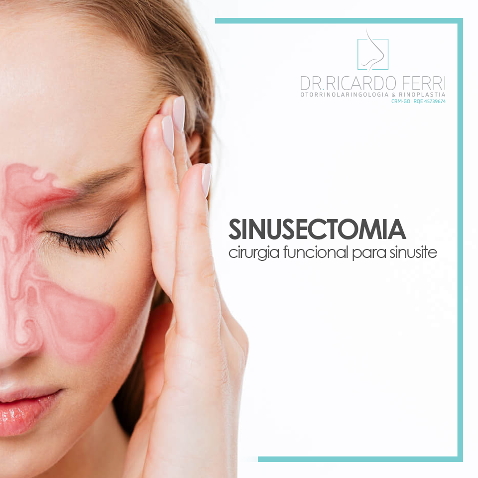 Sinusectomia: a cirurgia funcional para sinusite - Dr. Ricardo Ferri